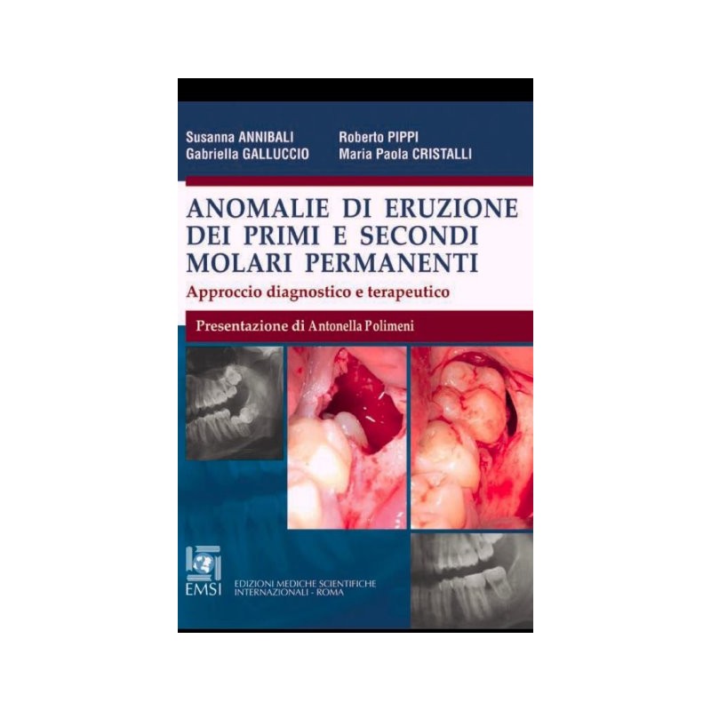 Anomalie di eruzione dei primi e secondi molari permanenti - Approccio diagnostico e terapeutico